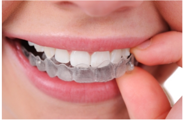 تقويم الأسنان الشفاف (Clear Aligners)